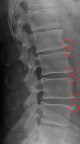 bico de papagaio ou osteofito