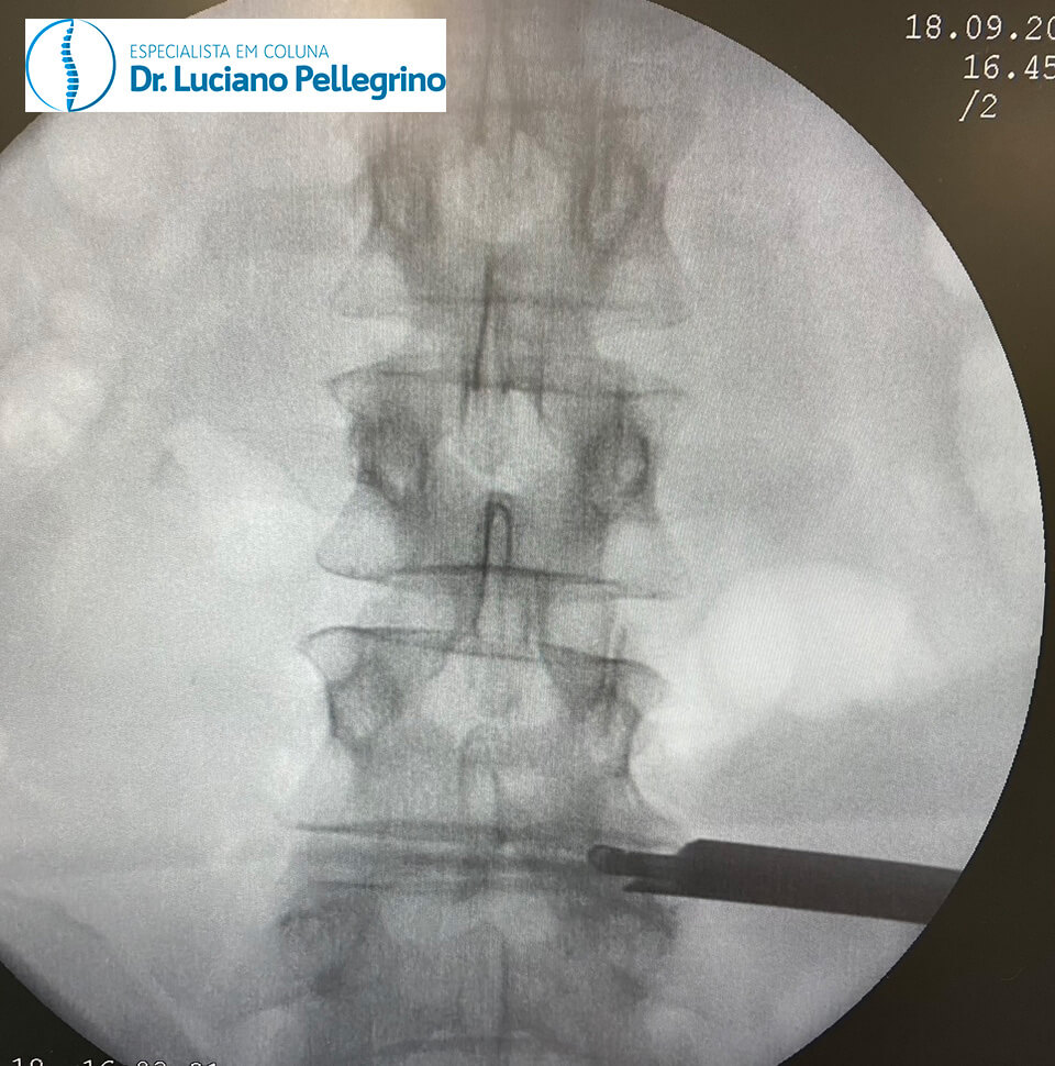 radioscopia na coluna