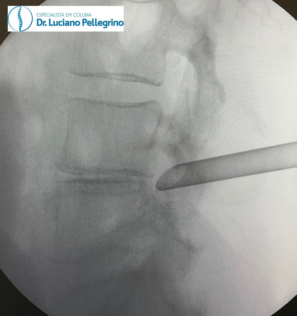 radioscopia na coluna
