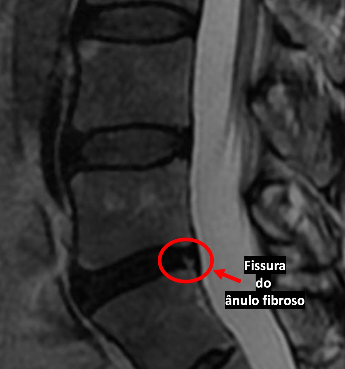 Fissura do ânulo fibroso