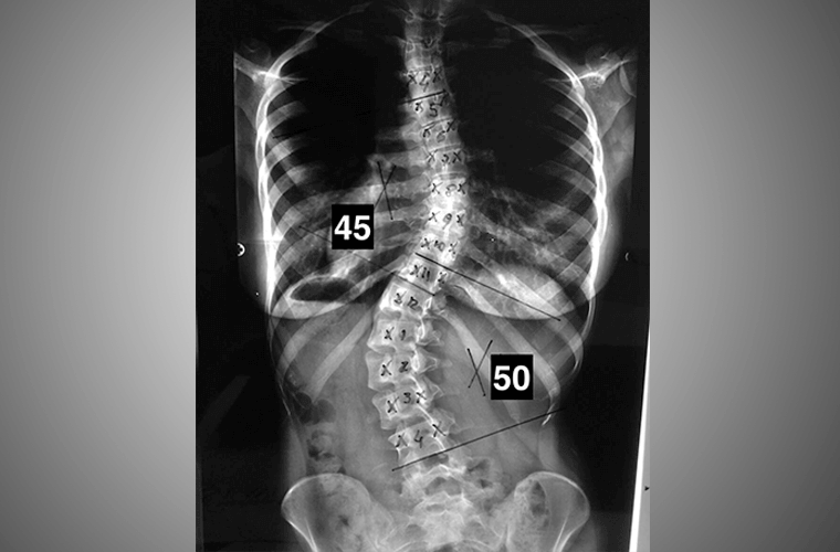 Radiografia ortopédica Traumatologia dor nas costas lesão da coluna  vertebral Ilustração por ©edwardolive #74475923