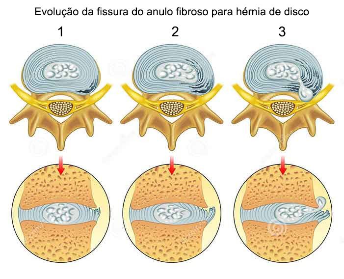 fissura do anulo fibroso