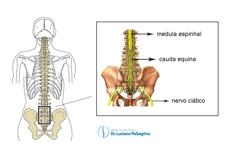 Síndrome da Cauda Equina - Um Caso de Emergência