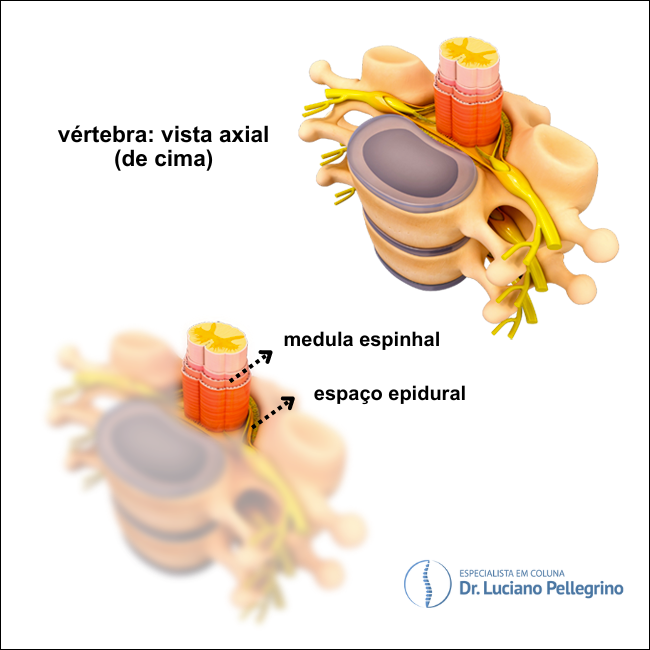 espaco epidural