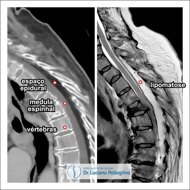 lipomatose epidural