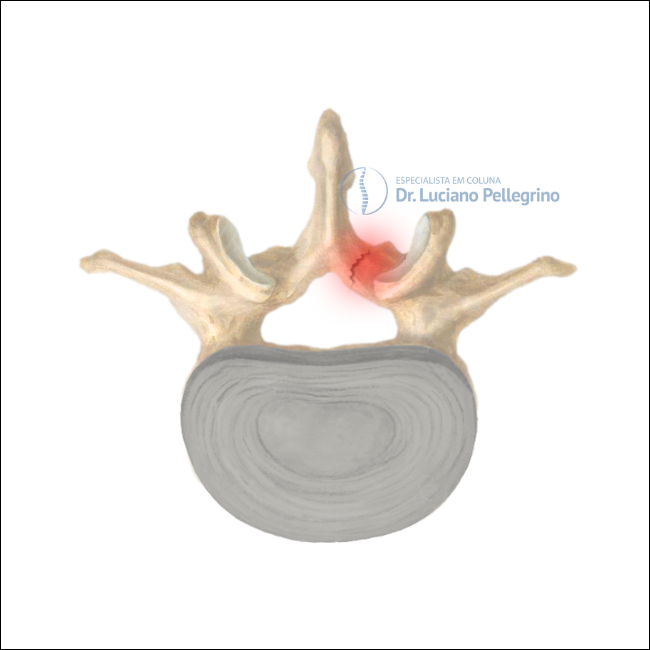 espondilólise unilateral (ou bilateral)