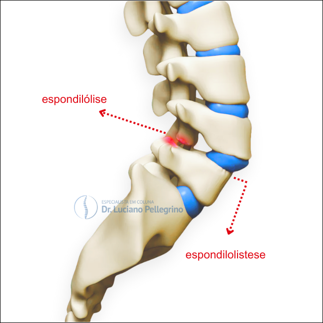 espondilólise e espondilolistese